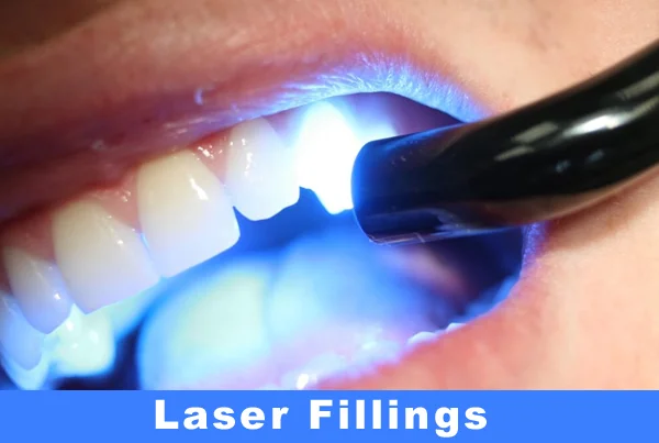 Laser Filling